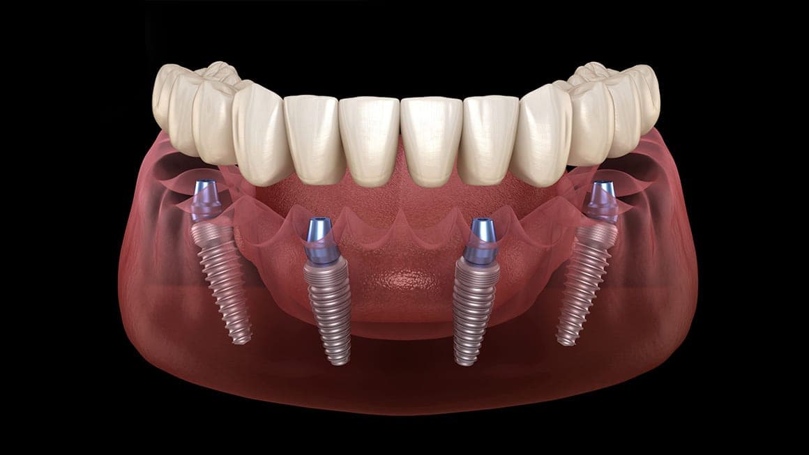 All-on-Four Implants