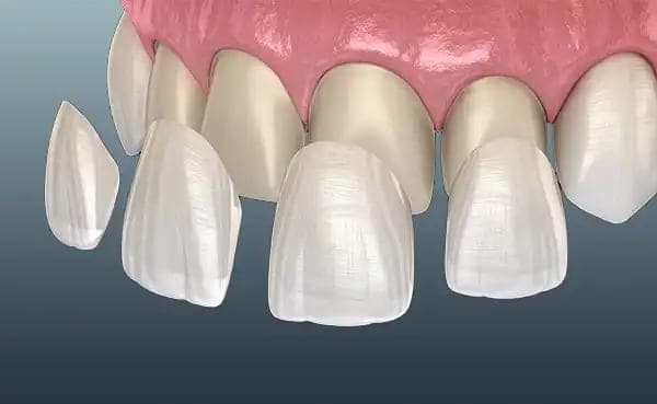E-Max Crowns