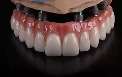 Dental Prosthetics