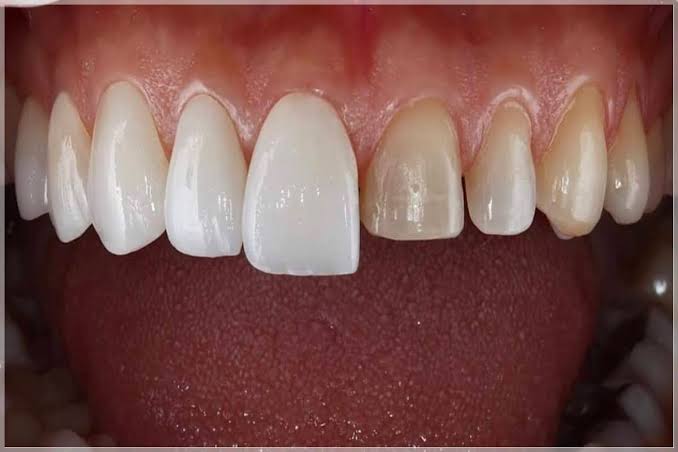Zirconia Crowns