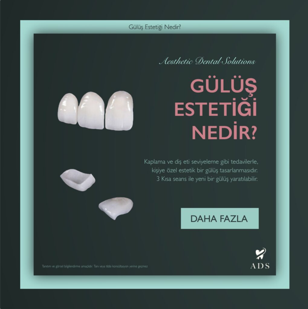 gülüş estetiği nedir
