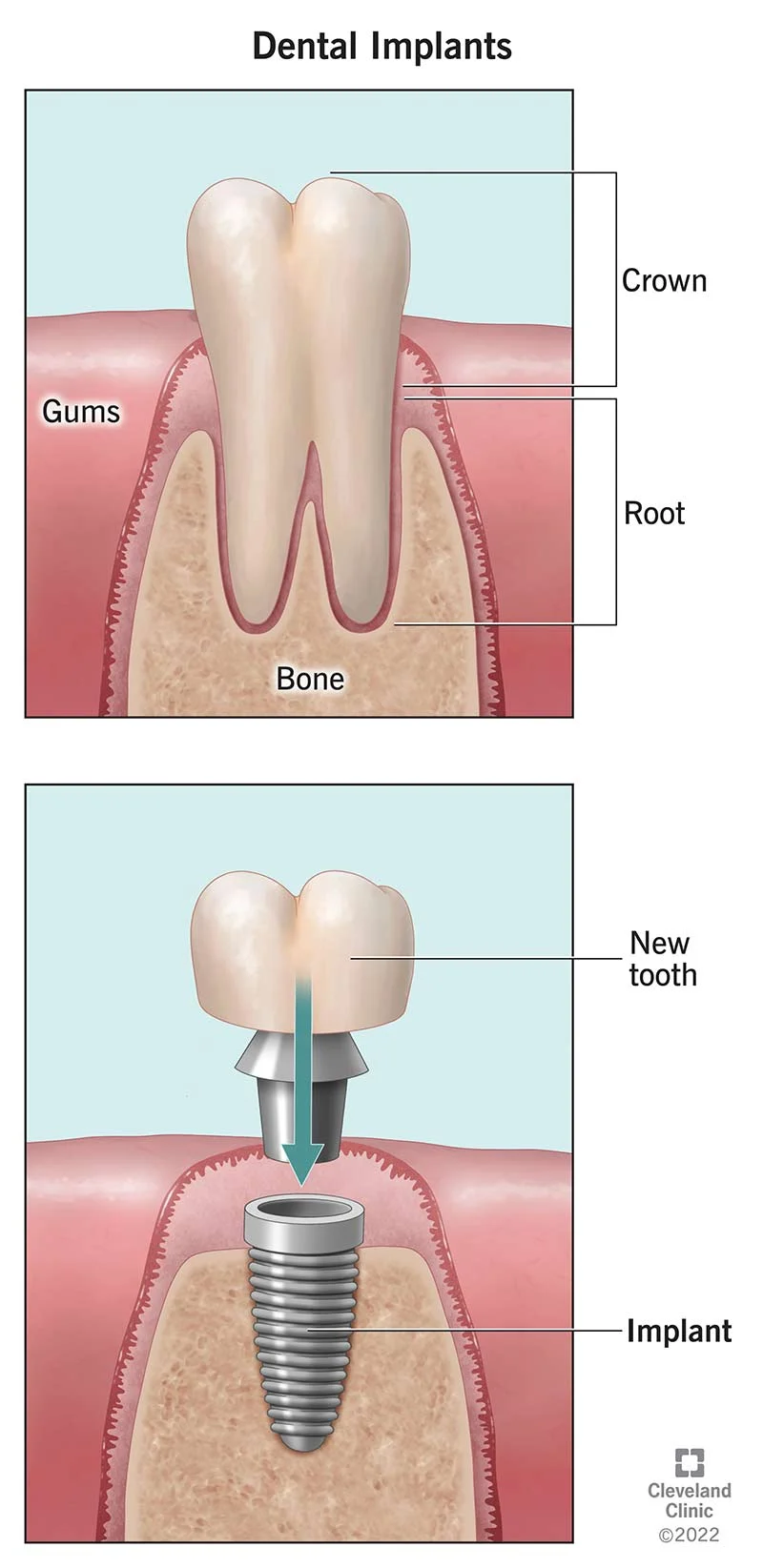 Dental Implants
