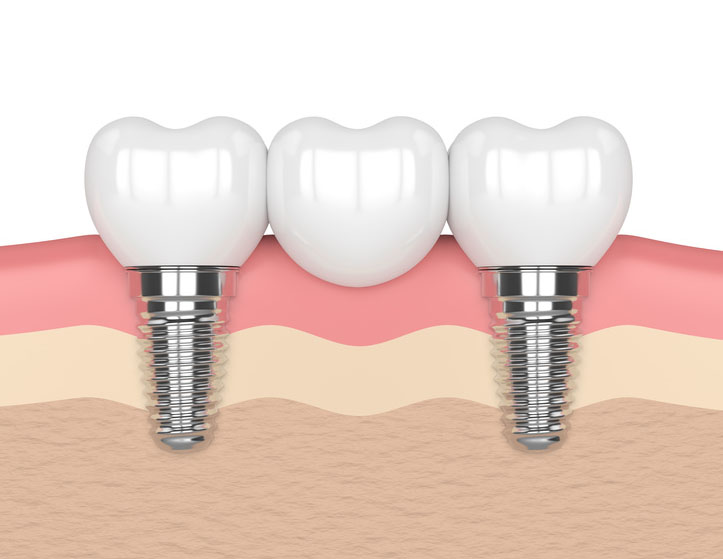 dental implant izmir diş implantı